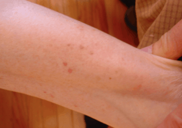 fleas bite mark