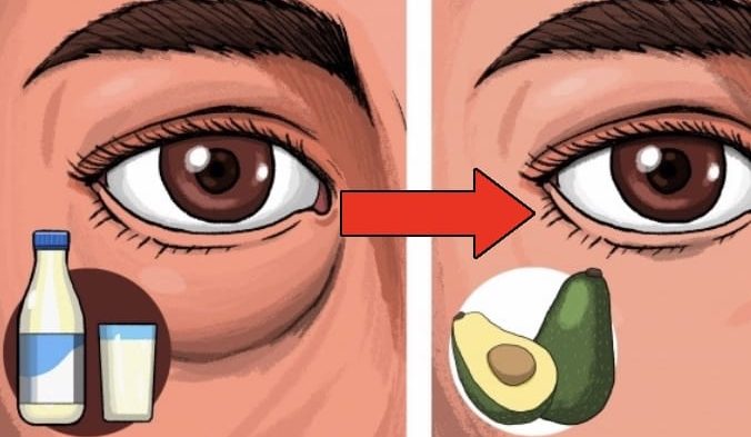 Quick Ways to Get Rid of Puffy Eyes & Dark Circle