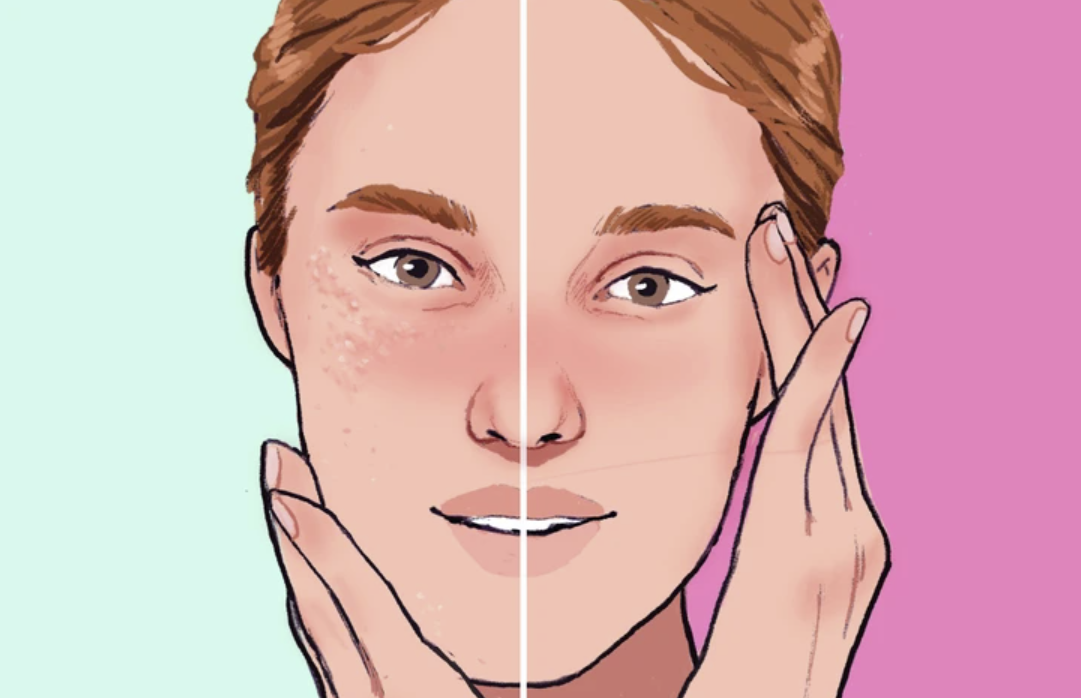 how to get rid of pimples fast