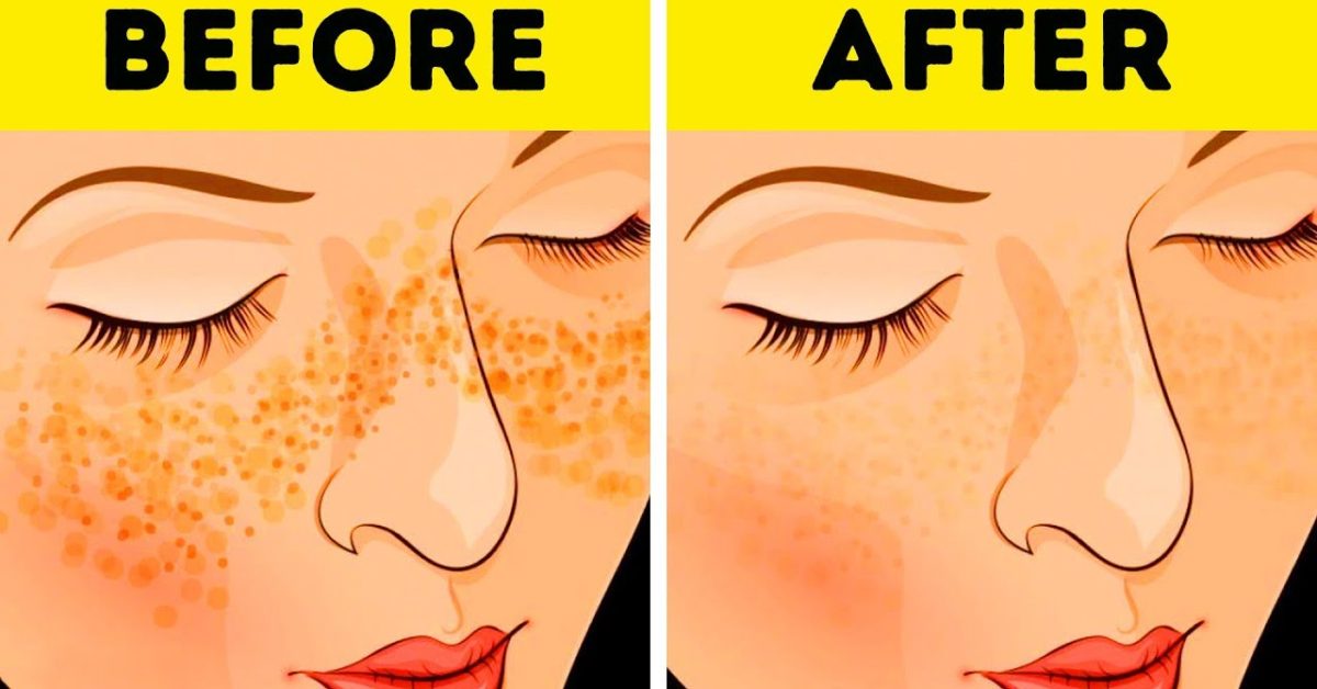 how to get rid of pores